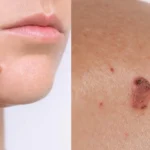 Քաղցկեղի 2 ընդհանուր նշաններ, որոնք կարելի է շոշափել մարմնի վրա